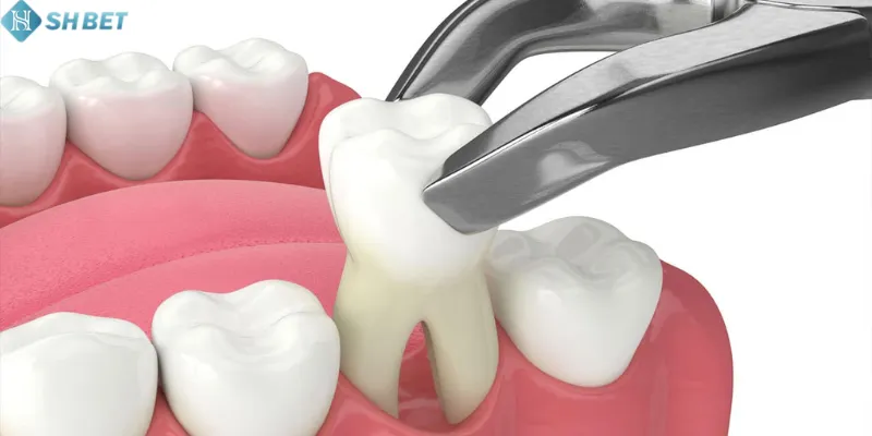  Cùng SHBET giải mã ý nghĩa giấc mơ nhổ răng